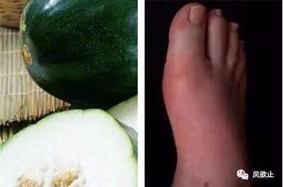 痛风可以吃籽瓜
